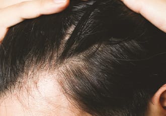 薄毛対策